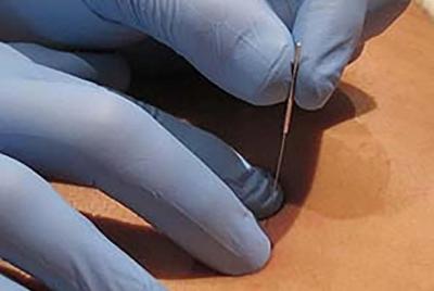 Dry Needling Therapy Dry Needling Therapy